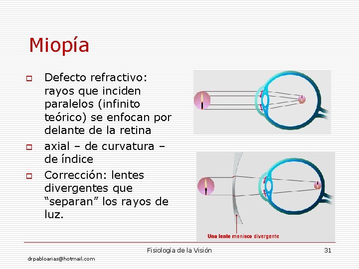 Miopía o o o Defecto refractivo: rayos que inciden paralelos (infinito teórico) se enfocan