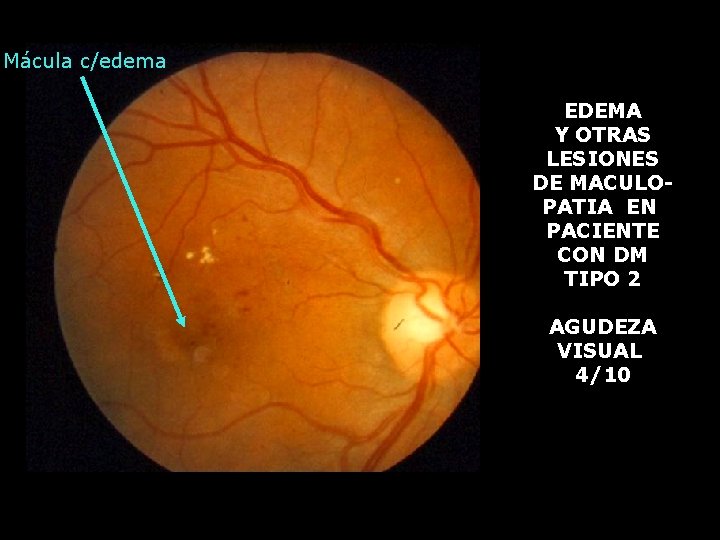 Mácula c/edema AGUDEZA VISUAL EDEMA Y OTRAS LESIONES DE MACULOPATIA EN PACIENTE CON DM
