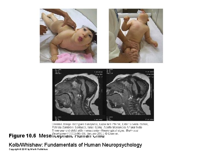 Figure 10. 6 Mesencephalic Human Child Kolb/Whishaw: Fundamentals of Human Neuropsychology Copyright © 2015