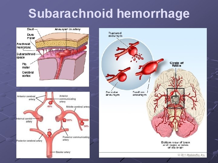 Subarachnoid hemorrhage 