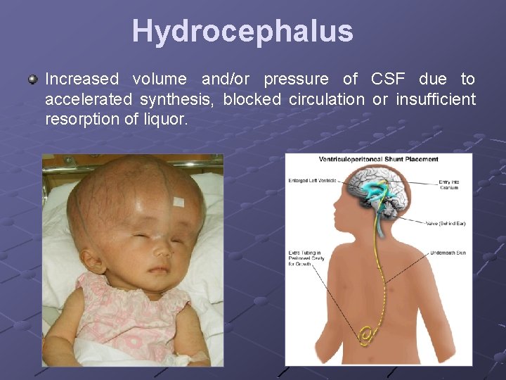 Hydrocephalus Increased volume and/or pressure of CSF due to accelerated synthesis, blocked circulation or