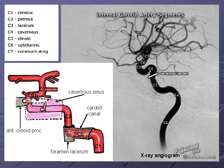C 7 C 6 C 5 cavernous sinus carotid canal C 4 C 3