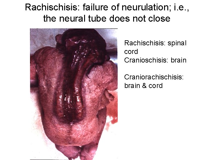 Rachisis: failure of neurulation; i. e. , the neural tube does not close Rachisis: