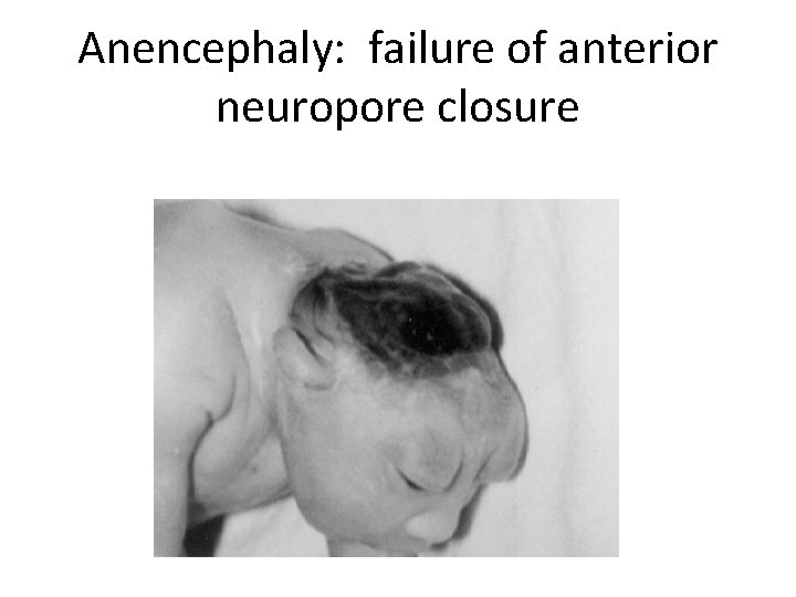 Anencephaly: failure of anterior neuropore closure 