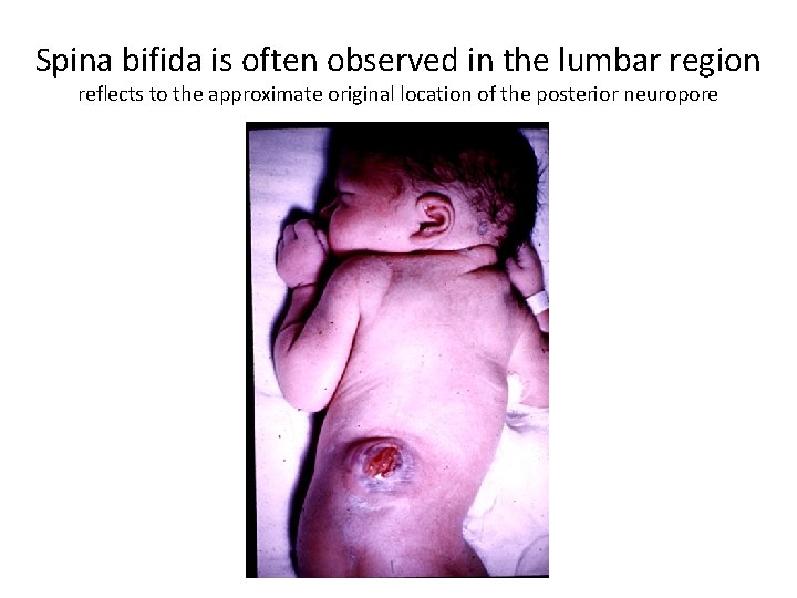 Spina bifida is often observed in the lumbar region reflects to the approximate original
