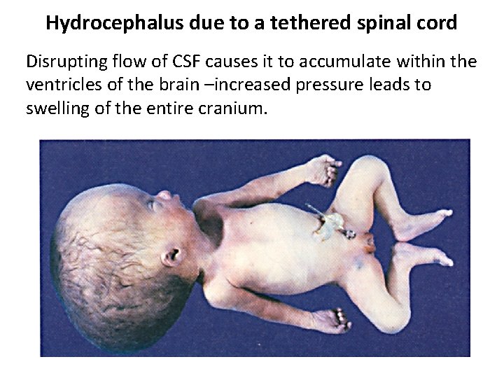 Hydrocephalus due to a tethered spinal cord Disrupting flow of CSF causes it to