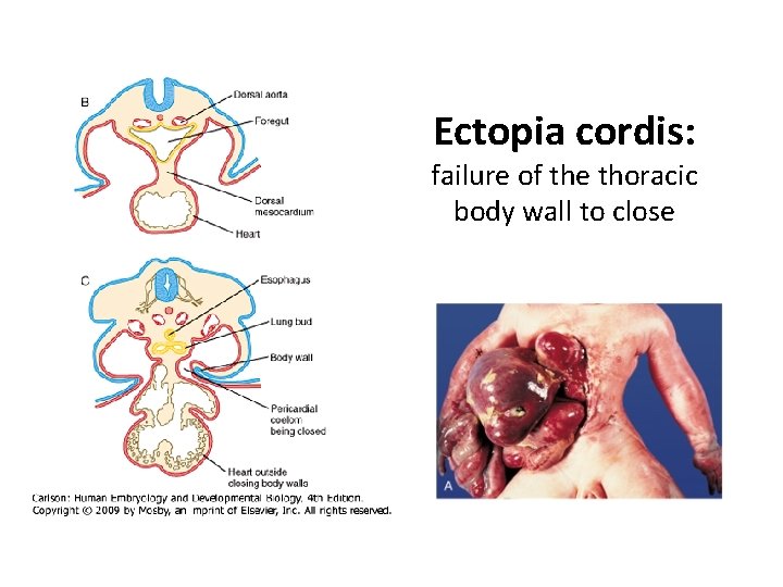 Ectopia cordis: failure of the thoracic body wall to close 