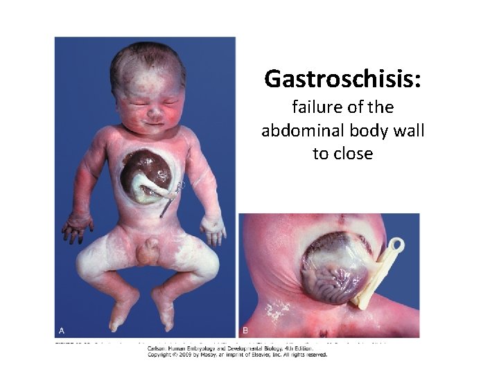 Gastroschisis: failure of the abdominal body wall to close 