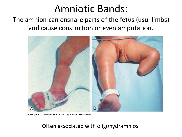 Amniotic Bands: The amnion can ensnare parts of the fetus (usu. limbs) and cause
