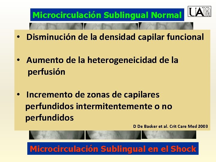 Microcirculación Sublingual Normal • Disminución de la densidad capilar funcional • Aumento de la
