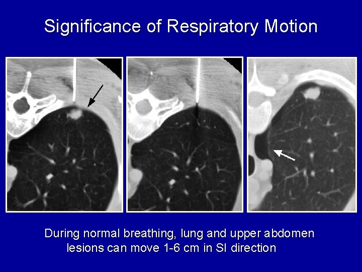 Significance of Respiratory Motion During normal breathing, lung and upper abdomen lesions can move