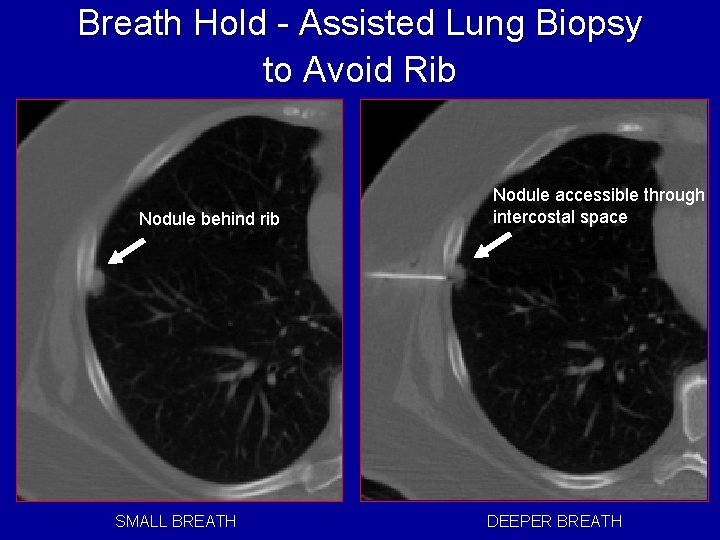 Breath Hold - Assisted Lung Biopsy to Avoid Rib Nodule behind rib SMALL BREATH