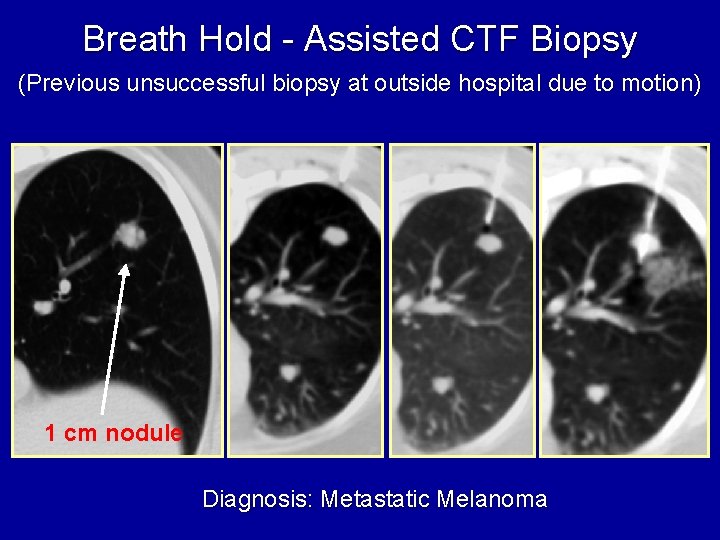 Breath Hold - Assisted CTF Biopsy (Previous unsuccessful biopsy at outside hospital due to