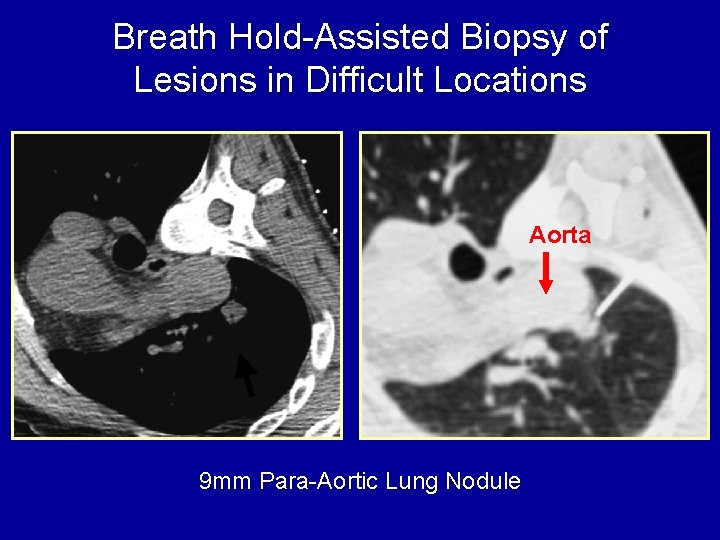 Breath Hold-Assisted Biopsy of Lesions in Difficult Locations Aorta 9 mm Para-Aortic Lung Nodule