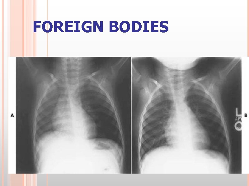 FOREIGN BODIES 