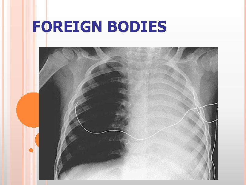 FOREIGN BODIES 