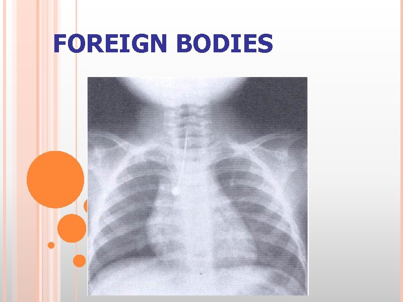 FOREIGN BODIES 