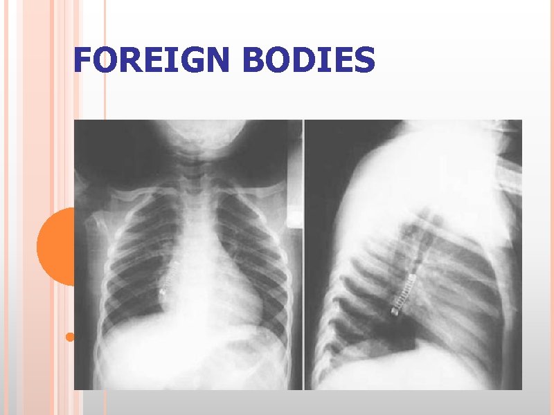 FOREIGN BODIES 