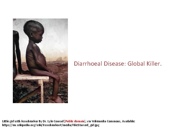 Diarrhoeal Disease: Global Killer. Little girl with kwashiorkor By Dr. Lyle Conrad [Public domain],