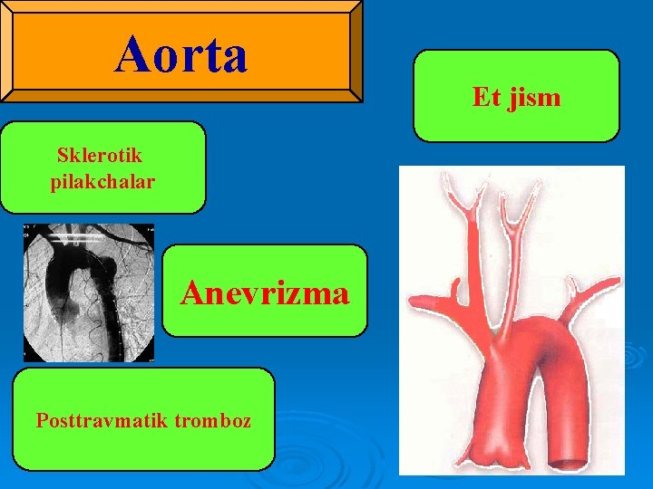 Аоrta Sklerotik pilakchalar Аnevrizma Posttravmatik tromboz Et jism 