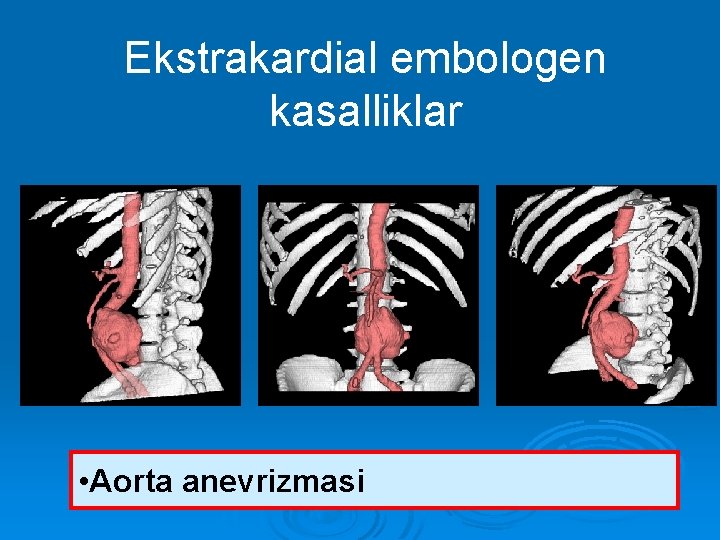 Ekstrakardial embologen kasalliklar • Aorta anevrizmasi 