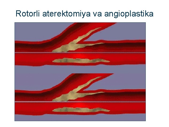 Rotorli aterektomiya va angioplastika 