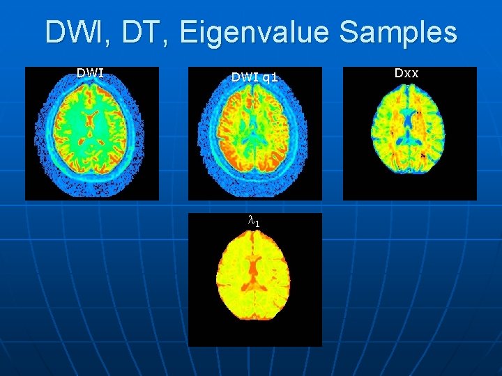 DWI, DT, Eigenvalue Samples DWI q 1 l 1 Dxx 