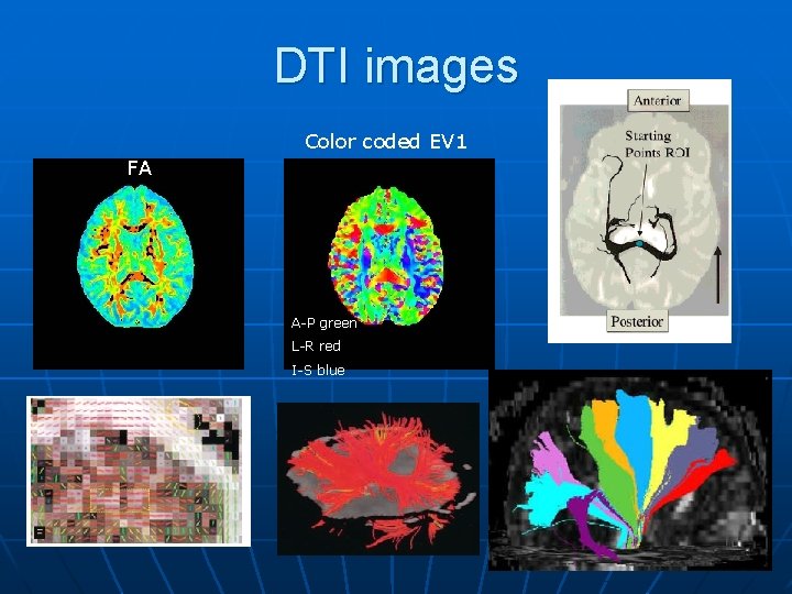 DTI images Color coded EV 1 FA A-P green L-R red I-S blue 