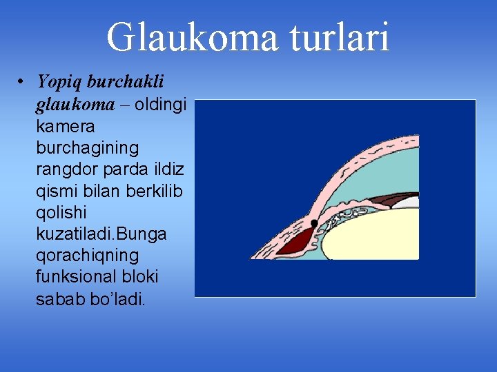 Glaukoma turlari • Yopiq burchakli glaukoma – oldingi kamera burchagining rangdor parda ildiz qismi