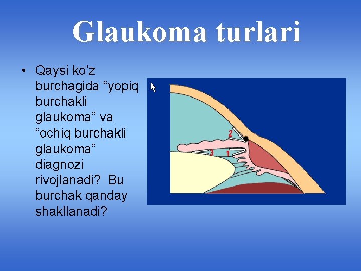 Glaukoma turlari • Qaysi ko’z burchagida “yopiq burchakli glaukoma” va “ochiq burchakli glaukoma” diagnozi