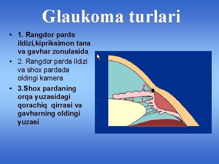 Glaukoma turlari • 1. Rangdor parda ildizi, kipriksimon tana va gavhar zonulasida • 2.