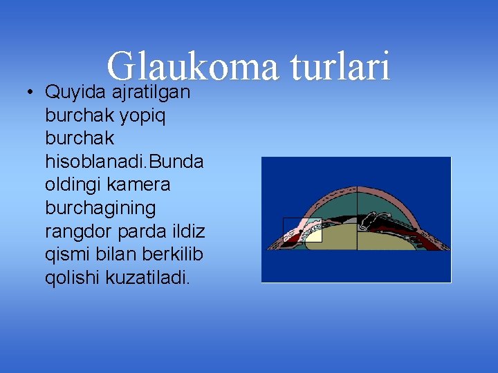 Glaukoma turlari • Quyida ajratilgan burchak yopiq burchak hisoblanadi. Bunda oldingi kamera burchagining rangdor