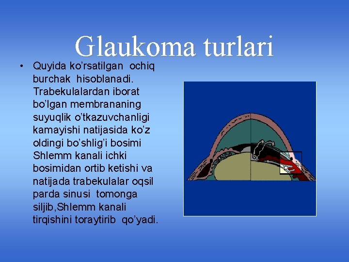 Glaukoma turlari • Quyida ko’rsatilgan ochiq burchak hisoblanadi. Trabekulalardan iborat bo’lgan membrananing suyuqlik o’tkazuvchanligi