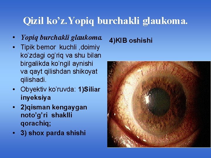 Qizil ko’z. Yopiq burchakli glaukoma. • Yopiq burchakli glaukoma. 4)KIB oshishi • Tipik bemor