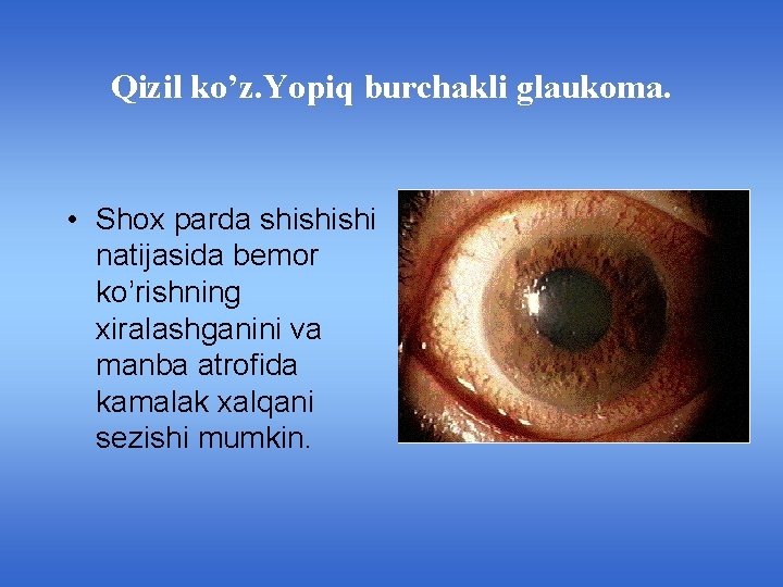 Qizil ko’z. Yopiq burchakli glaukoma. • Shox parda shishishi natijasida bemor ko’rishning xiralashganini va