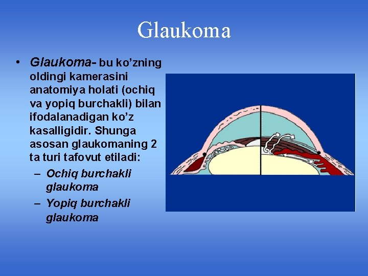 Glaukoma • Glaukoma- bu ko’zning oldingi kamerasini anatomiya holati (ochiq va yopiq burchakli) bilan