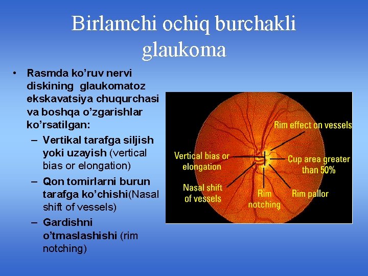 Birlamchi ochiq burchakli glaukoma • Rasmda ko’ruv nervi diskining glaukomatoz ekskavatsiya chuqurchasi va boshqa