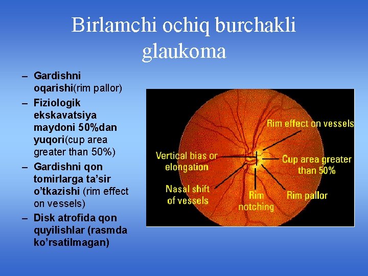 Birlamchi ochiq burchakli glaukoma – Gardishni oqarishi(rim pallor) – Fiziologik ekskavatsiya maydoni 50%dan yuqori(cup