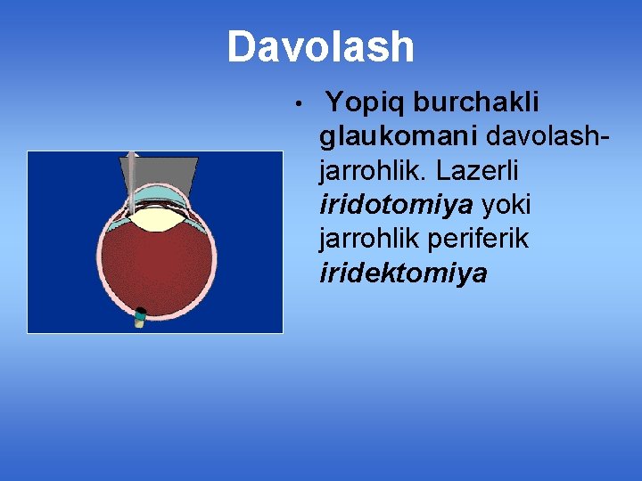Davolash • Yopiq burchakli glaukomani davolashjarrohlik. Lazerli iridotomiya yoki jarrohlik periferik iridektomiya 
