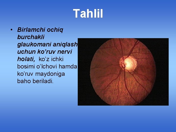 Tahlil • Birlamchi ochiq burchakli glaukomani aniqlash uchun ko’ruv nervi holati, ko’z ichki bosimi