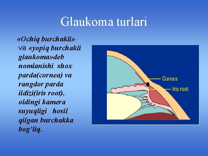 Glaukoma turlari «Ochiq burchakli» va «yopiq burchakli glaukoma» deb nomlanishi shox parda(cornea) va rangdor