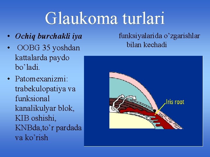 Glaukoma turlari • Ochiq burchakli iya • OOBG 35 yoshdan kattalarda paydo bo’ladi. •