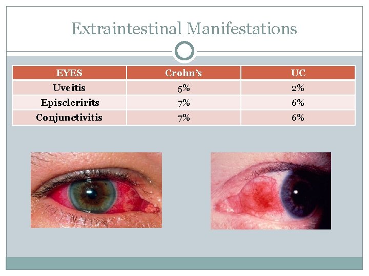 Extraintestinal Manifestations EYES Crohn’s UC Uveitis 5% 2% Episcleririts 7% 6% Conjunctivitis 7% 6%