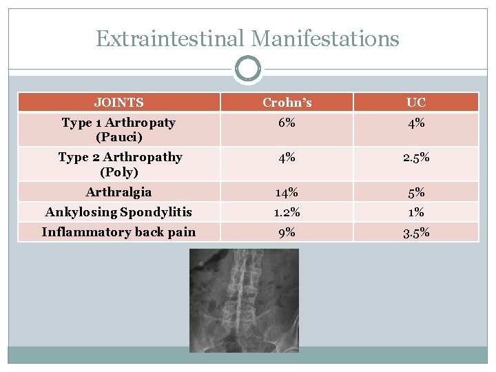 Extraintestinal Manifestations JOINTS Crohn’s UC Type 1 Arthropaty (Pauci) 6% 4% Type 2 Arthropathy