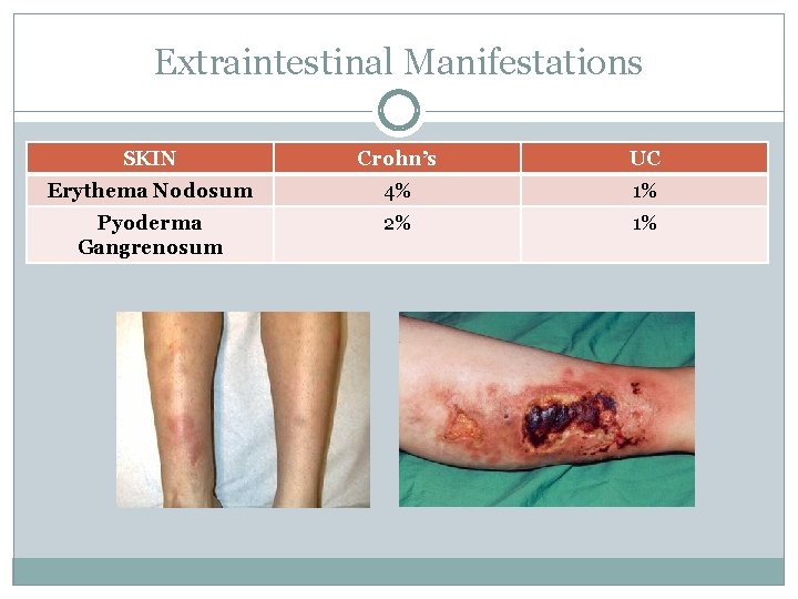 Extraintestinal Manifestations SKIN Crohn’s UC Erythema Nodosum 4% 1% Pyoderma Gangrenosum 2% 1% 