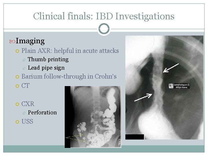 Clinical finals: IBD Investigations Imaging Plain AXR: helpful in acute attacks Thumb printing Lead
