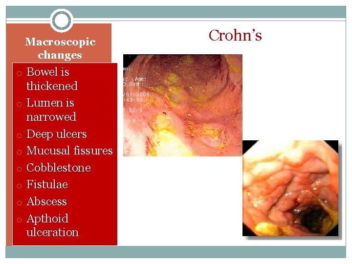 Macroscopic changes o Bowel is o o o o thickened Lumen is narrowed Deep