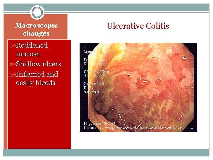 Macroscopic changes Reddened mucosa Shallow ulcers Inflamed and easily bleeds Ulcerative Colitis 