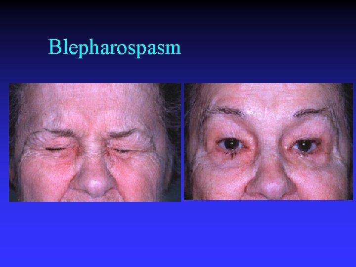 Blepharospasm 