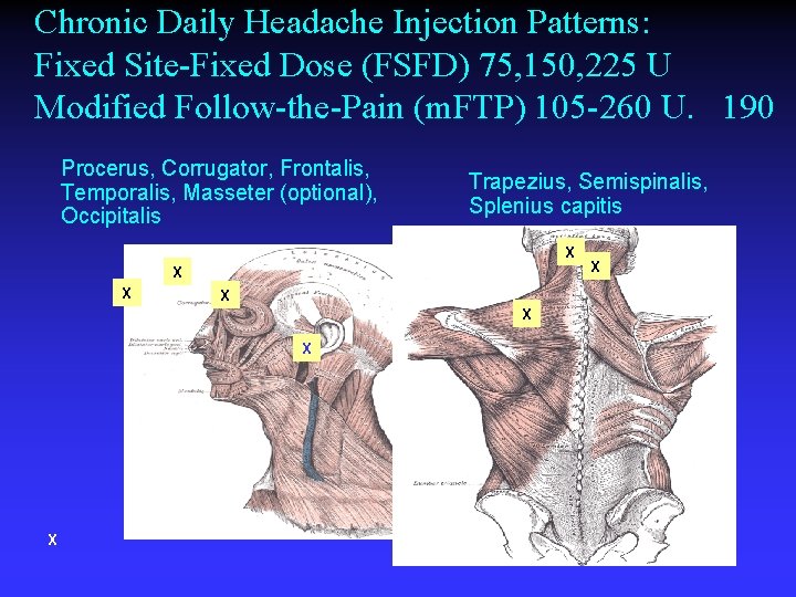 Chronic Daily Headache Injection Patterns: Fixed Site-Fixed Dose (FSFD) 75, 150, 225 U Modified